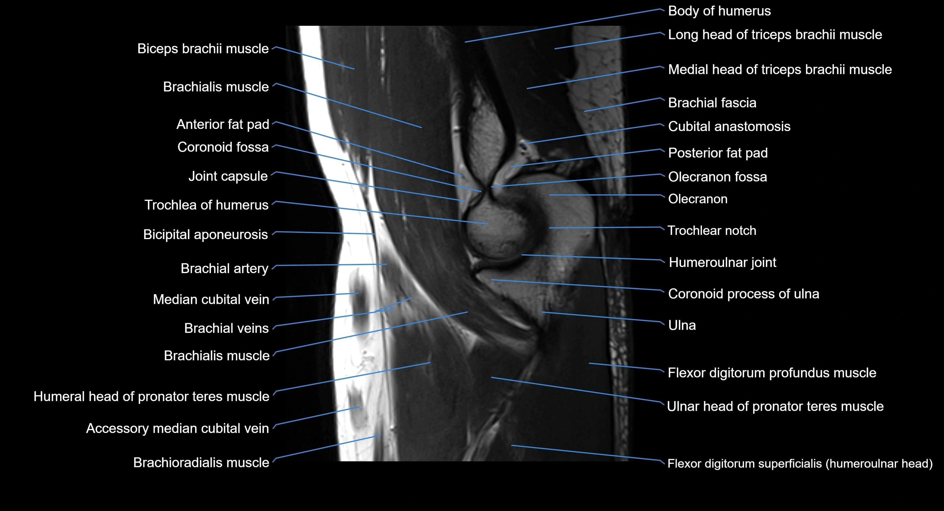 MRI elbow joint  sagittal cross sectional anatomy 3T  radiology  image-img-00001-00012.webp